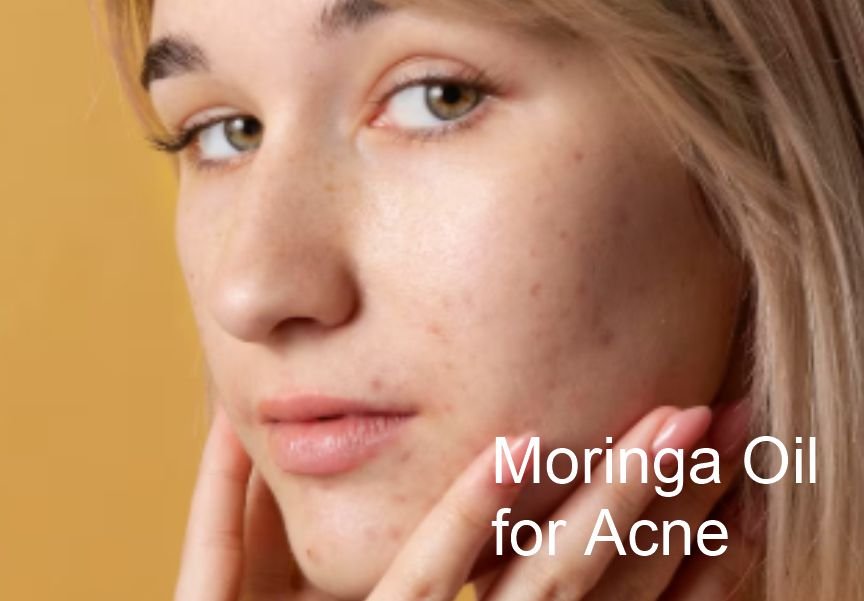 A lady Who is Yet to Learn How to Use Moringa Oil for Acne